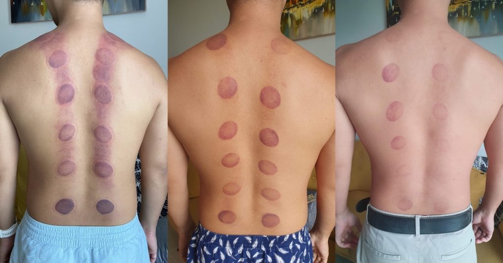 Da Nang Massage Cupping